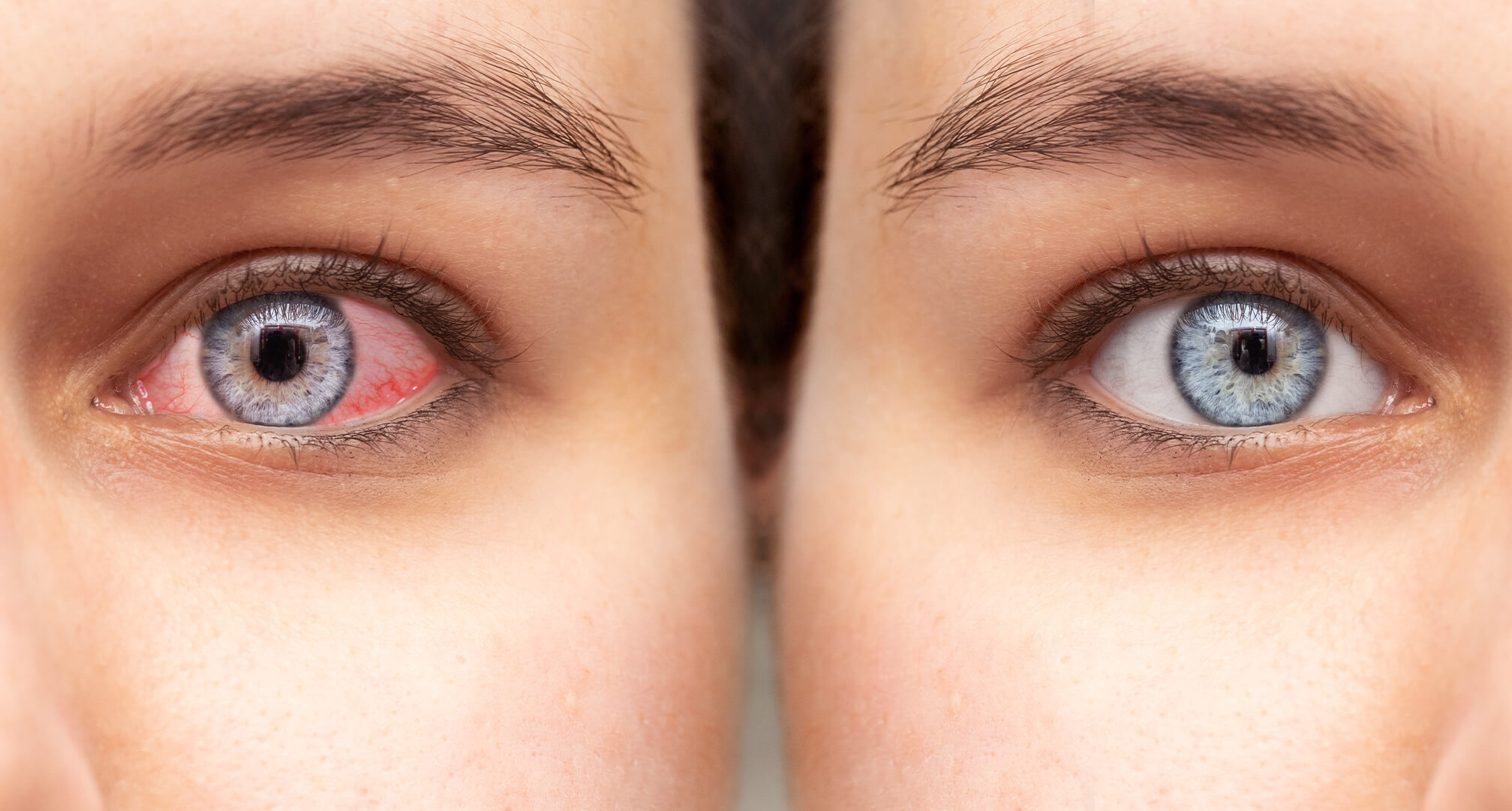 gros plan de deux yeux côte à côte, un œil rouge et sec à gauche et un œil sain à droite